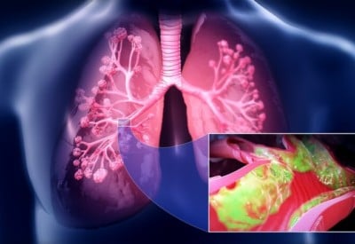 Animation picture of top half of body highlighting lungs