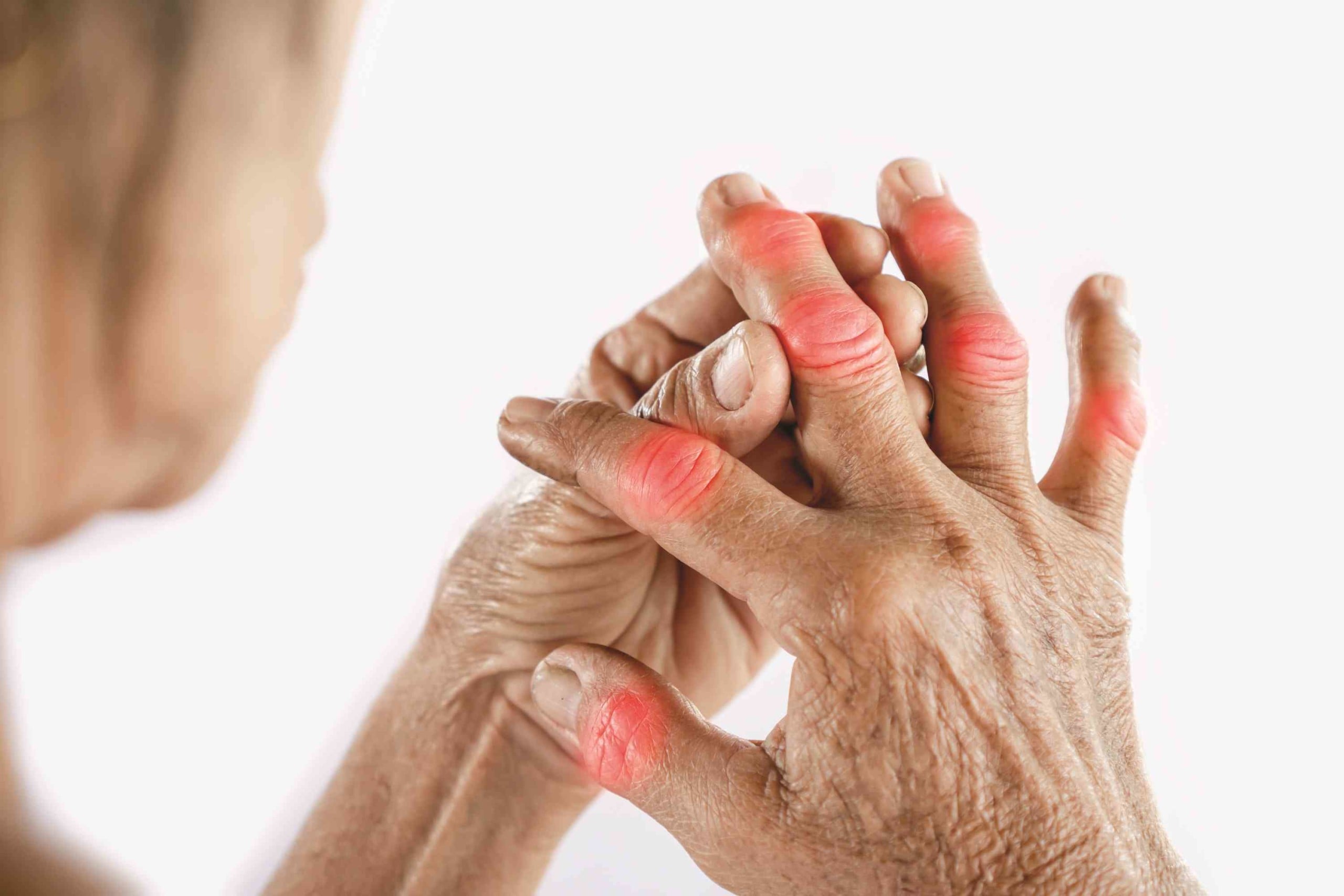 Painful hand osteoarthritis