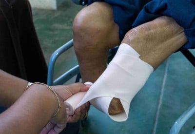 Amputated leg