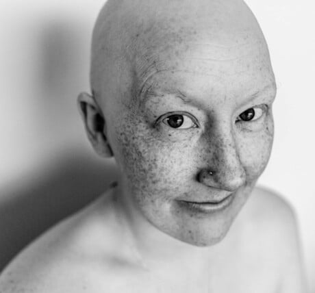 Grey and white photo of paige with no hair