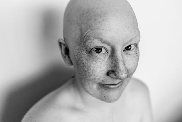 Grey and white photo of paige with no hair