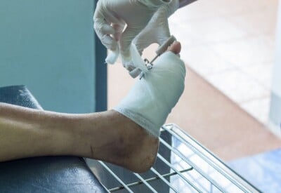 Foot ulcer bandaged up