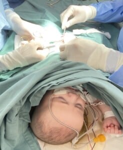 A newborn baby undergoing groin hernia surgery.